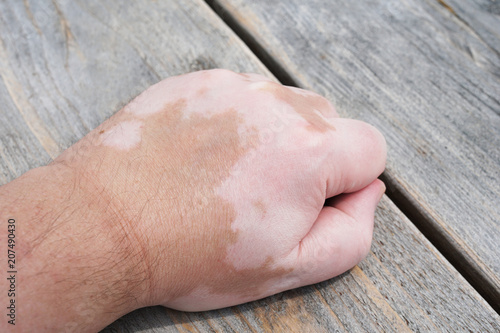 male hand with vitiligo skin condition, characterized by white unpigmented patches or blotches photo