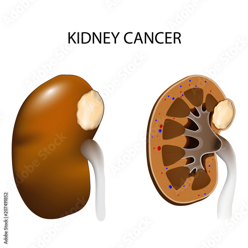 kidney cancer