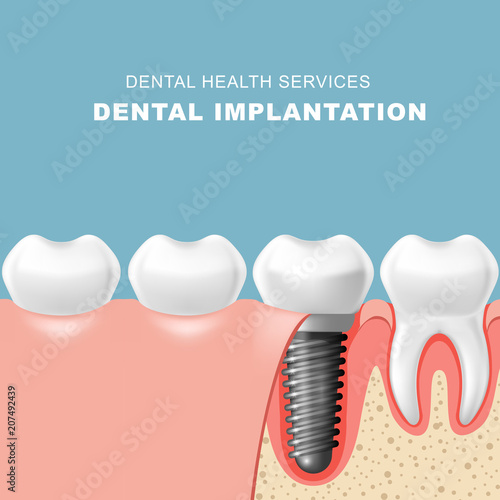 Teeth and dental implantat inserted into gum - tooth implantation