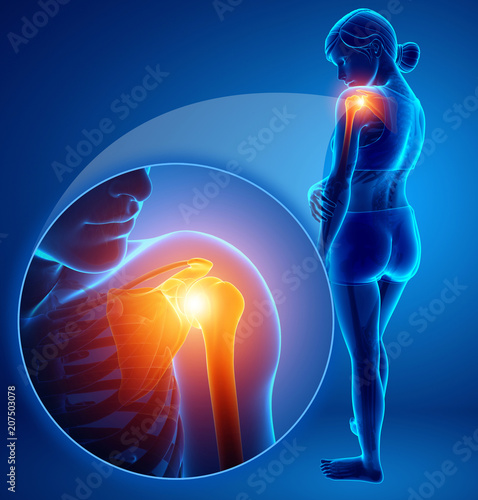 3d Illustration of Female Feeling the Shoulder Pain