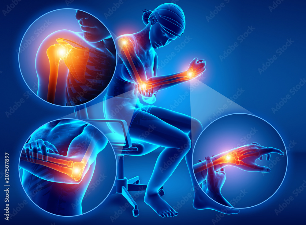 Foto de 3d Illustration of Female Feeling Arm joint pain do Stock