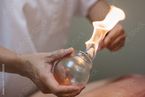 Woman preparing glass cup with flame for cupping therapy for pain relief