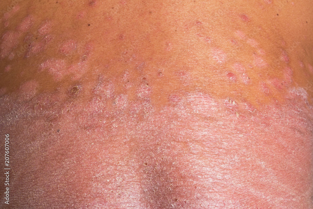 Fototapeta premium The back is full of psoriasis