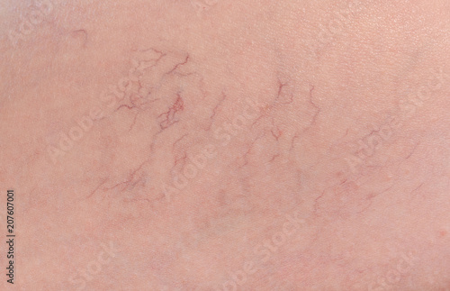 Spider veins. Varicose veins under woman skin