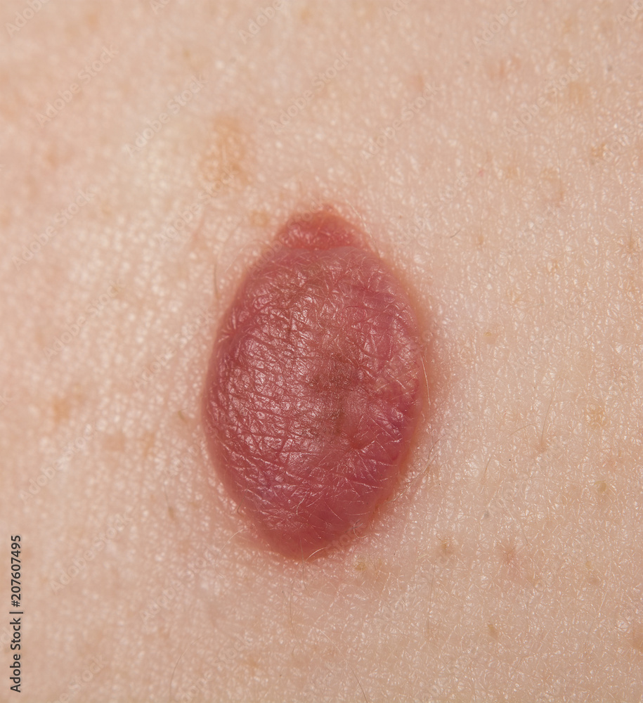 Inborn mole close up. Macro shot of benign skin lesion. Proliferation of pigment derma cells, melanocytic pigmented naevus, naevocytic nevus.