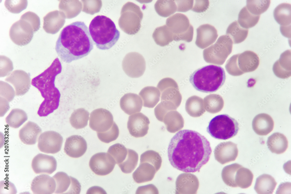 Blood smear of chronic lymphocytic leukemia (CLL), analyze by microscope