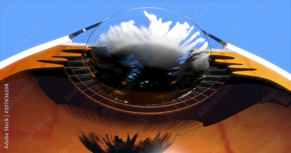 Posterior capsule opacification after cataract surgery, YAG laser