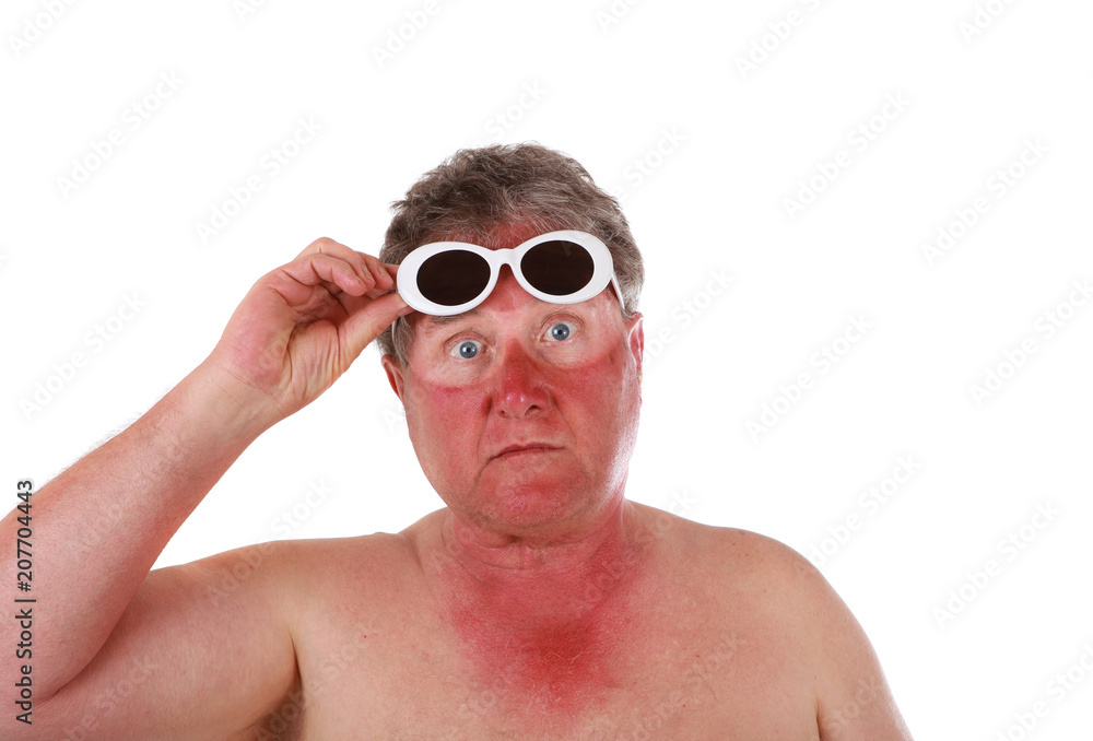 Sunburned man with sunglasses lines StockFoto Adobe Stock