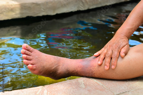 Natural hot spring relieves blood circulation, de-stressing, chronic pain,
solving skin conditions, heals Deep Vein Thrombosis problems on female legs.