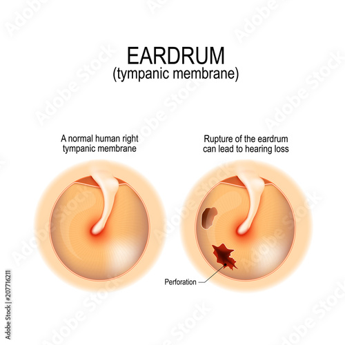 Ruptured (perforated) eardrum photo