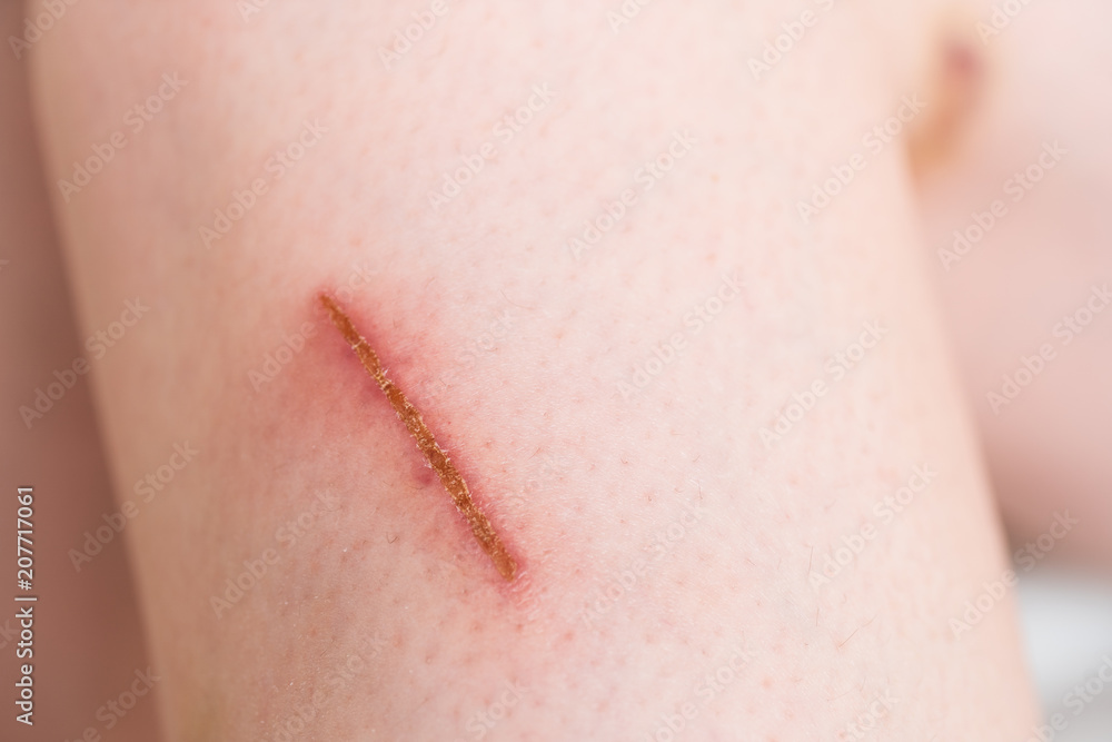 Fototapeta premium close up scar on skin
