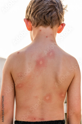 Boy child with many infected mosquito bites on his back. Skin with redness and allergic reaction.