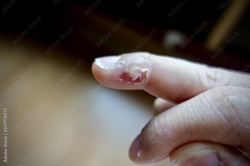 treatment wart on finger by salicylic acid, in this picture show what's happening after use