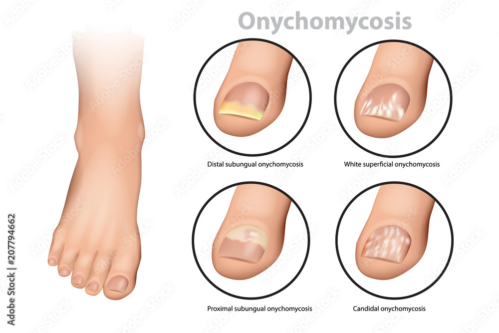 Fungal Nail Infection. Onychomycosis or tinea unguium. Four classic types  of onychomycosis Stock Vector