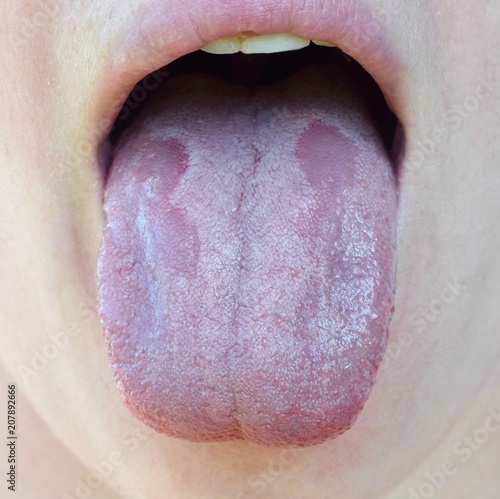 Oral Candidiasis or  Oral trush ( Candida albicans), yeast infection on the human tongue close up, common side effect when using antibiotics or another medicaments photo