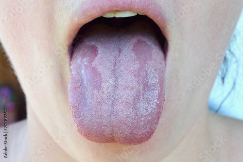 Obraz na plátne Oral Candidiasis or  Oral trush ( Candida albicans), yeast infection on the huma
