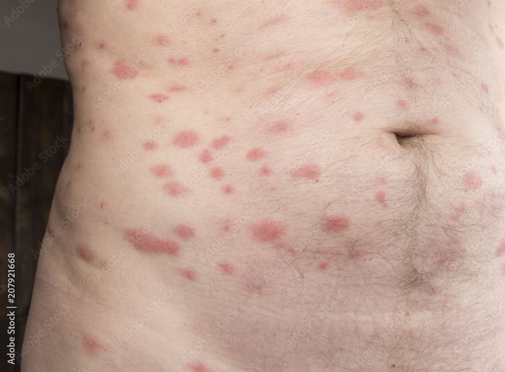 Fototapeta premium Bites of insect on male body. Bed bugs or flea.