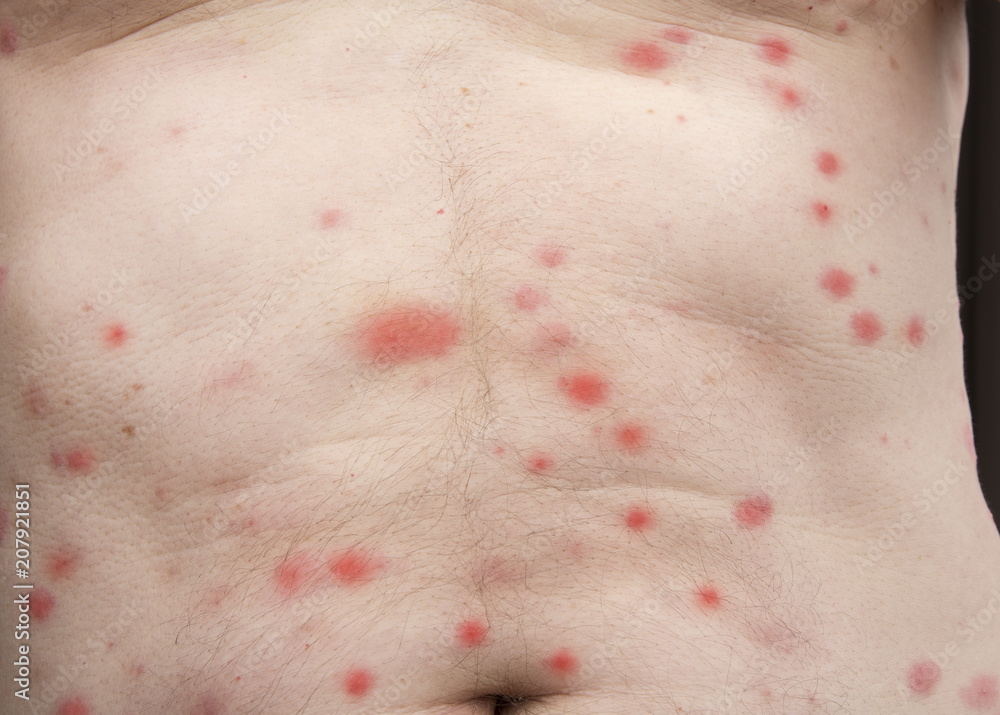 Fototapeta premium Bites of insect on male body. Bed bugs or flea.