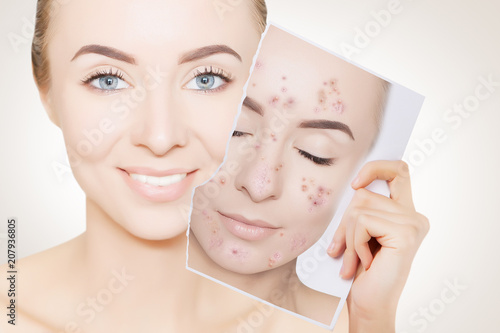 portrait of woman with clean skin holding portrait with pimpled skin photo