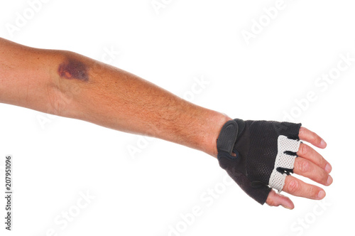 Bruise on cyclist arm on white background