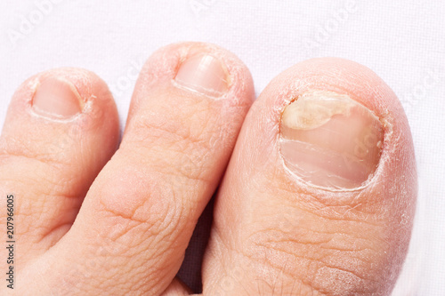 fungal nail infection (Onychomycosis). dry coarse skin of the legs (eczema)
