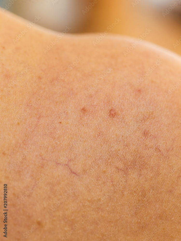 Fototapeta premium Ski with dilated capillaries ad red spots