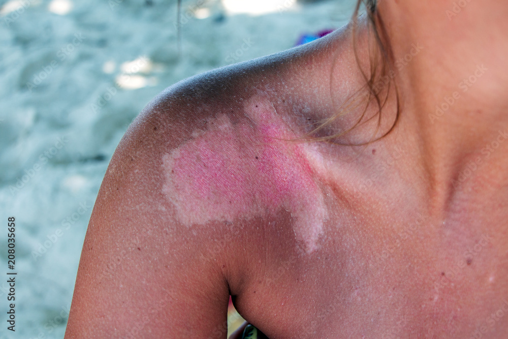 One big strong Sunburn on girls shoulder One big strong Sunburn on girls shoulder