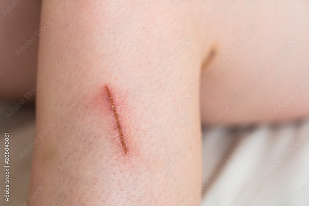 scratch fresh wounds Stock Photo Adobe Stock
