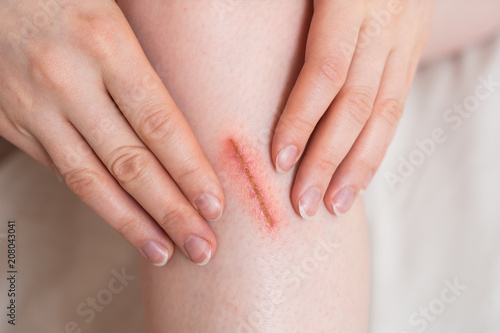 Obraz na plátne scratch fresh wounds
