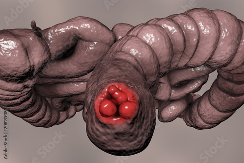 Photos Hemorrhoids, bottom view of hemorrhoic nodules inside anus, large and small inte