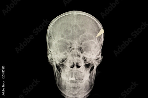 skull penetration injury