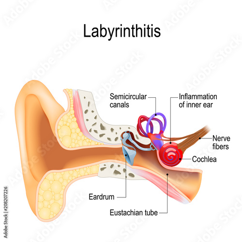 Labyrinthitis (vestibular neuritis)is the inflammation of inner ear photo