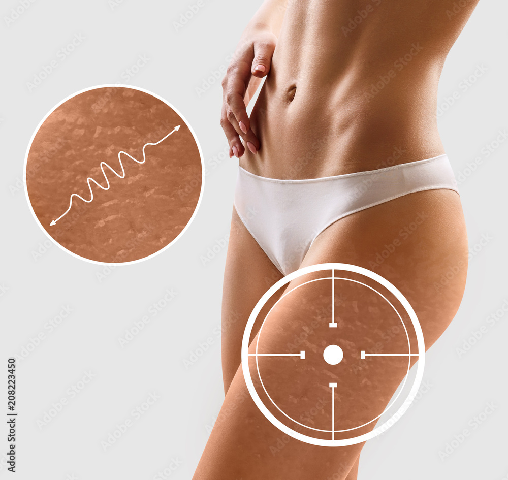 Zoom circle shows defect skin on hips. - obrazy, fototapety, plakaty 
