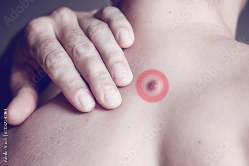 Fibroma on the male back, details, close-up