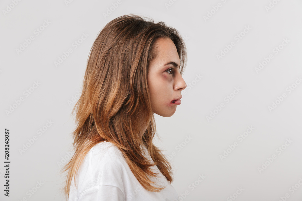 Fototapeta premium Serious disabled young girl with scratches and bruises