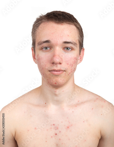 Handsome young man with skin problem