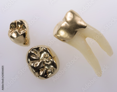 Goldkronen Gusskrone auf dem Zahn