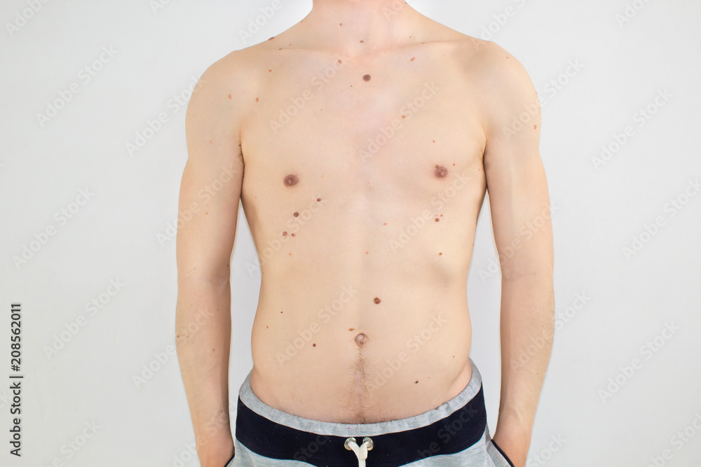 Body of a man with moles