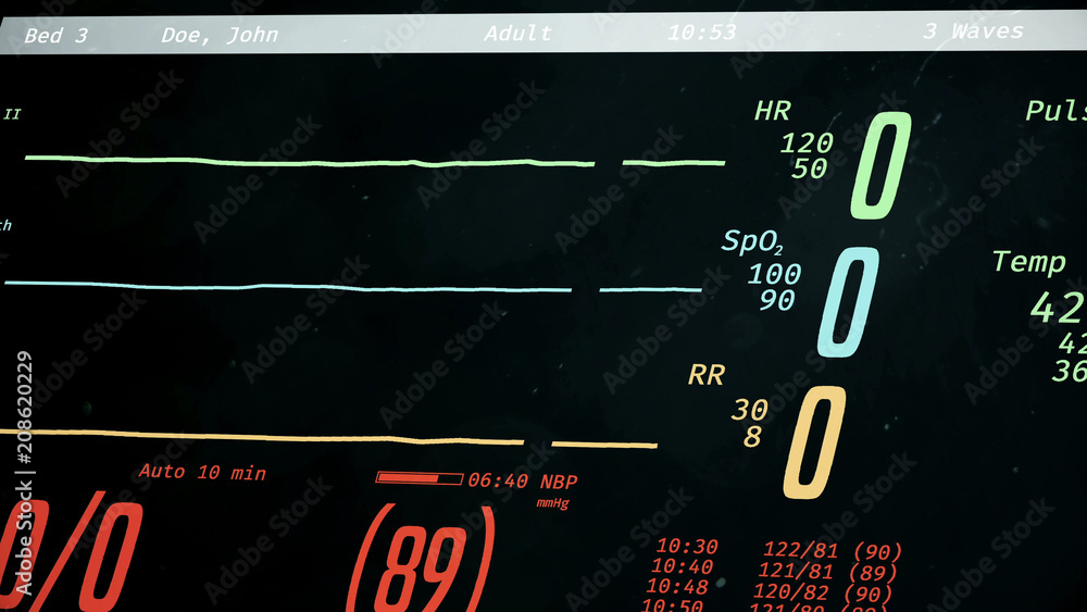 Patient dying, ICU monitor with dropping vital signs, cardiac arrest
