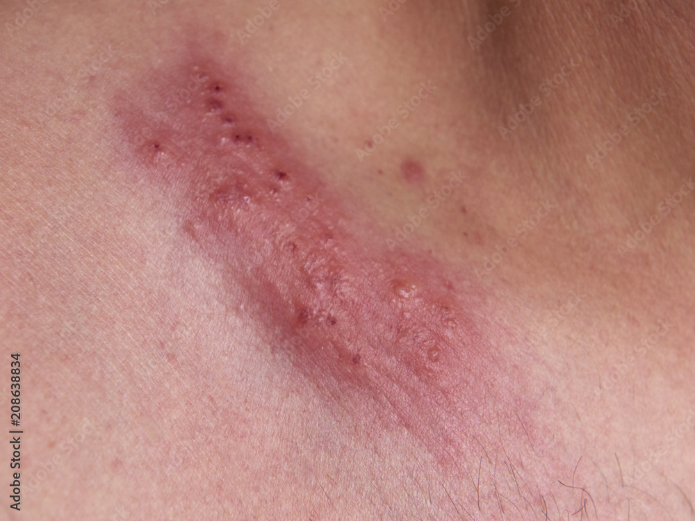Fototapeta premium Outbreak of herpes