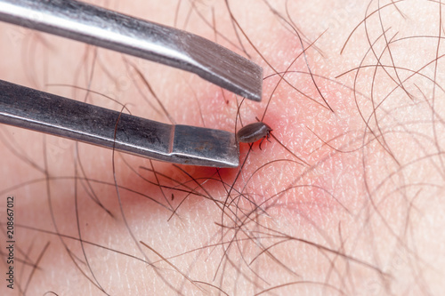 tick removal