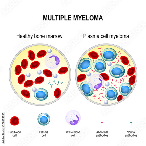 Multiple myeloma. plasma cell myeloma