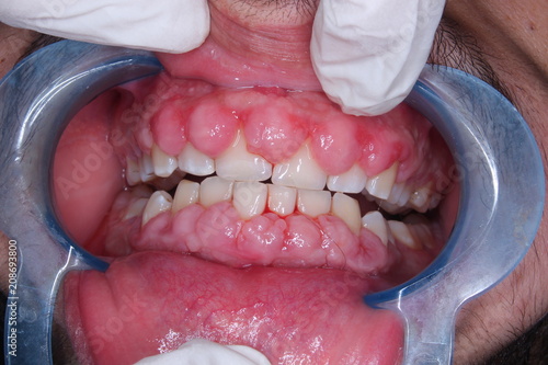 Bilde på lerret drug induced gingival enlargement