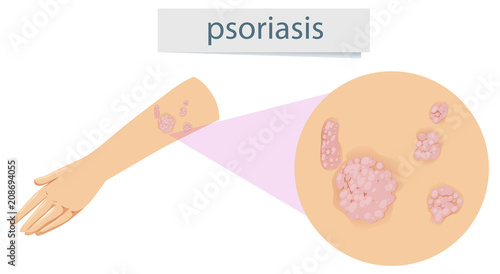 Magnified psoriasis on arm