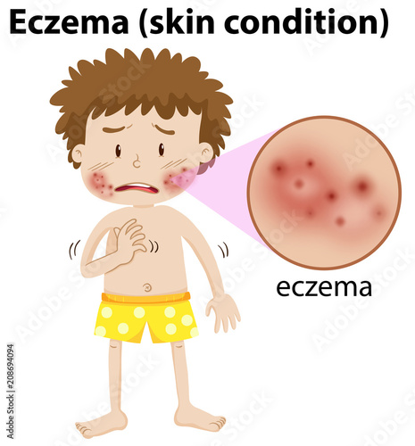A Young Boy Having Eczema