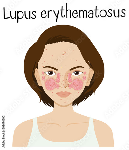A Vector of Lupus Erythematosus