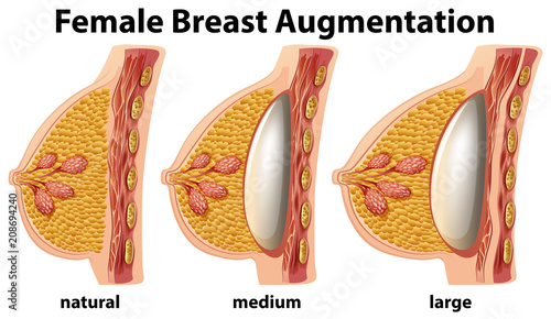 A Set of Female Breast Augmentation