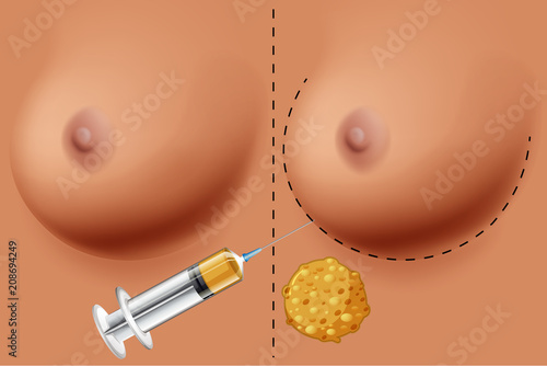 A Vector of Breast Surgery