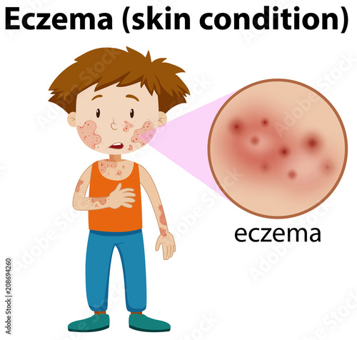 magnified eczema on young boy