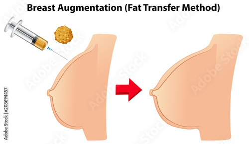 Breast augmentation fat transfer method